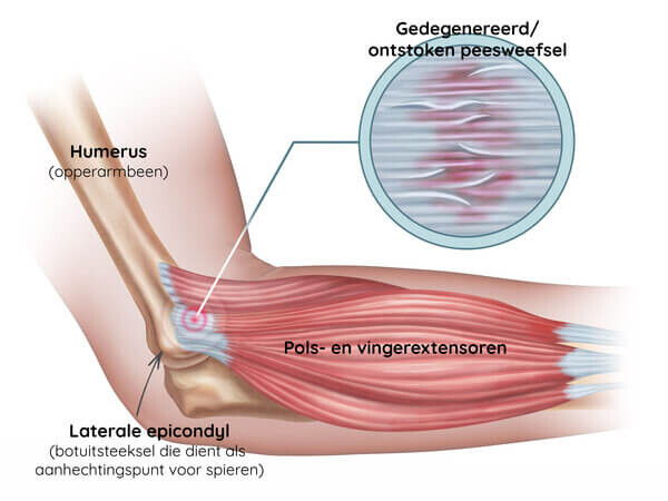 Tennisarm zelftest