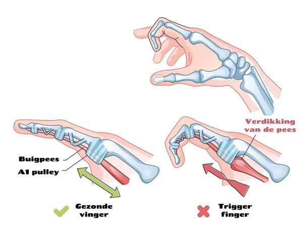 Triggerfinger met A1-pulley en buigpees